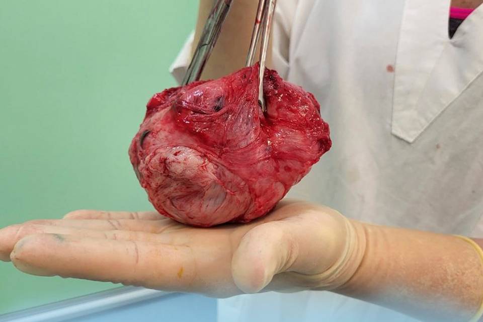Волгоградские хирурги во время родов удалили женщине миому размером с кулак