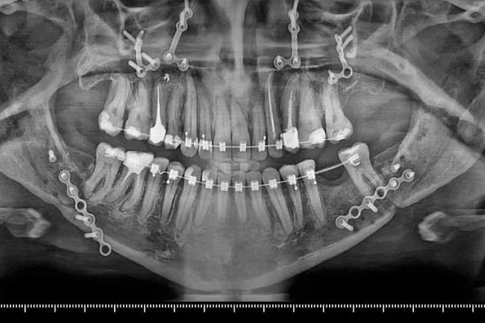 Волгоградские челюстно-лицевые хирурги исправили пациентке неправильный прикус