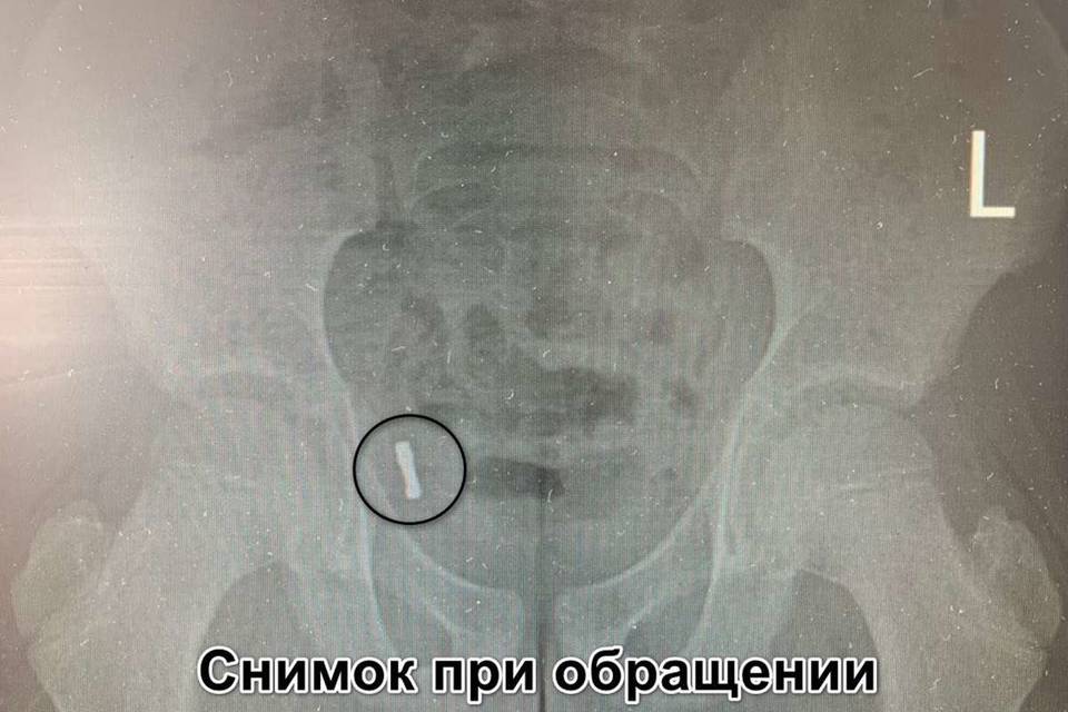 В Воронеже спасли ребенка с магнитами в аппендиксе