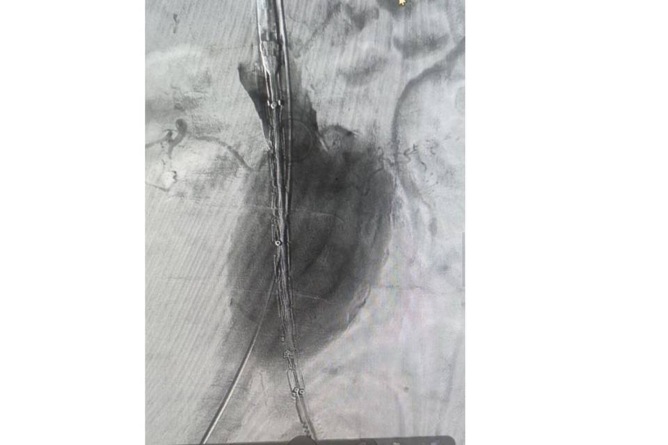 В Волгоградской областной больнице №1 прошла уникальная операция по лечению аневризмы