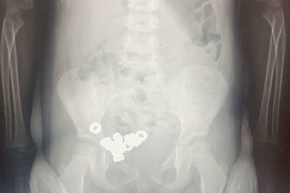 16 гаек проглотил маленький житель Воронежа