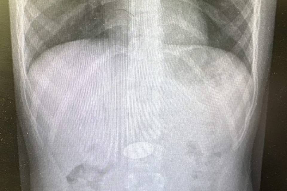 Волгоградские врачи спасли ребенка, проглотившего 5-рублевую монету