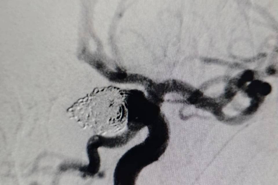 Врачи прооперировали женщину с разрывом аневризмы головного мозга в Волгограде