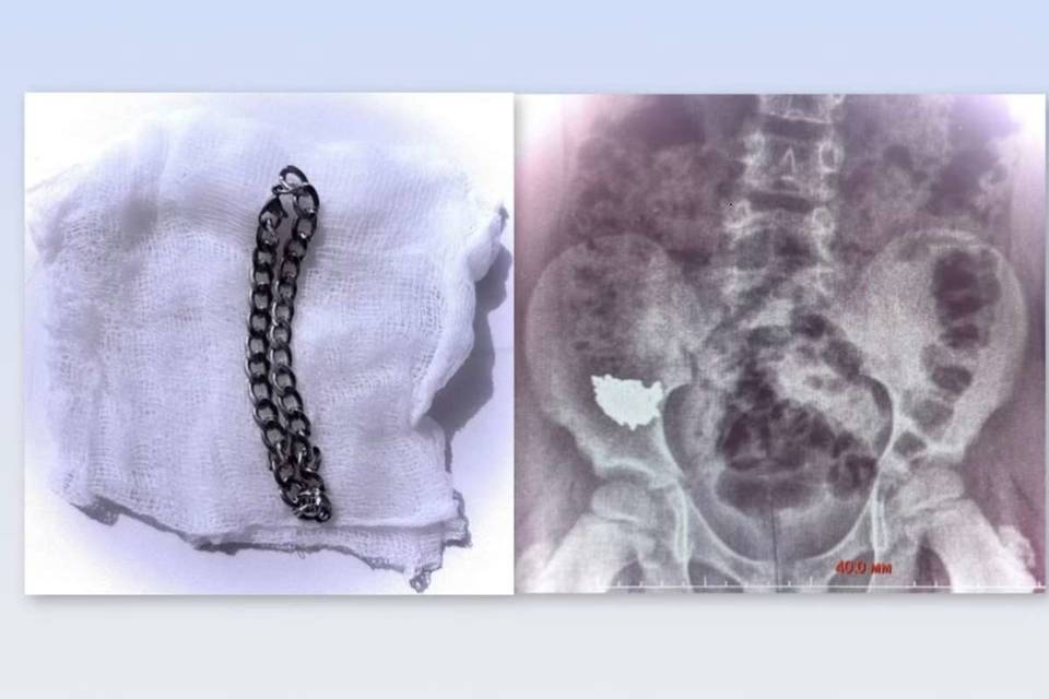 Врачи достали из живота школьника 20-сантиметровую цепь