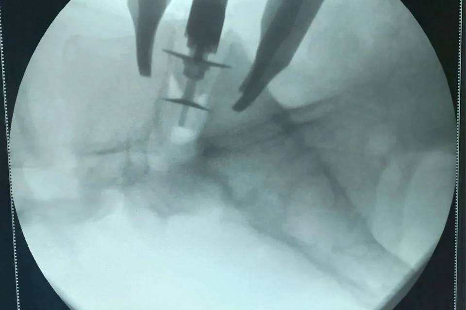 Нейрохирурги Волгограда освоили уникальную методику лечения позвоночника