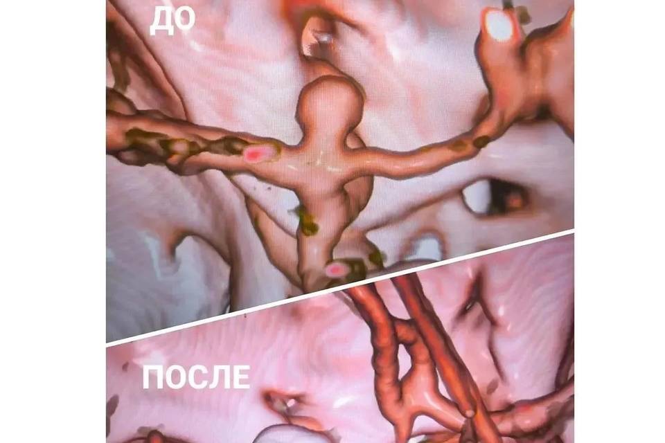 Пациентку с «бомбой замедленного действия» в голове спасли волгоградские врачи