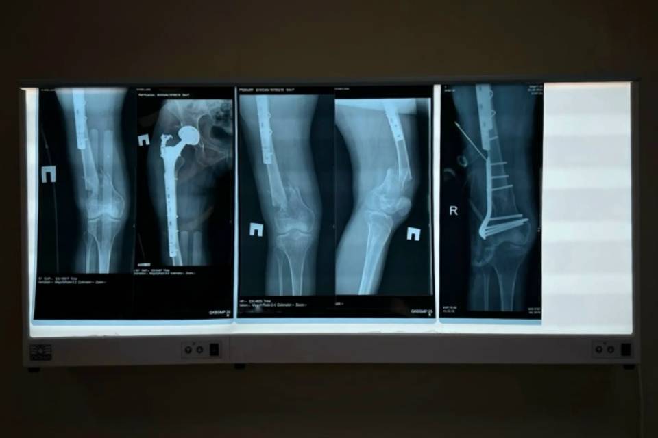 Волгоградские врачи сохранили ногу пациентке со сложнейшей травмой