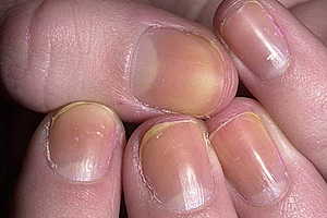 Медики рассказали, какие болезни можно определить по желтым ногтям